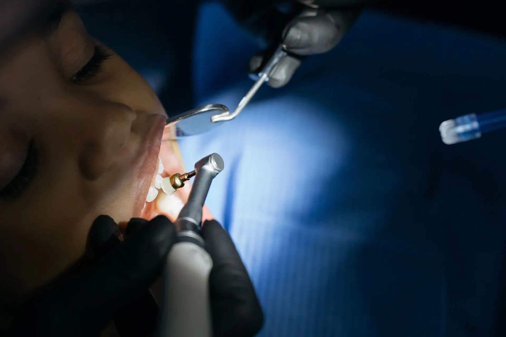 A dentist at work on a patient under the blue of a curing lamp