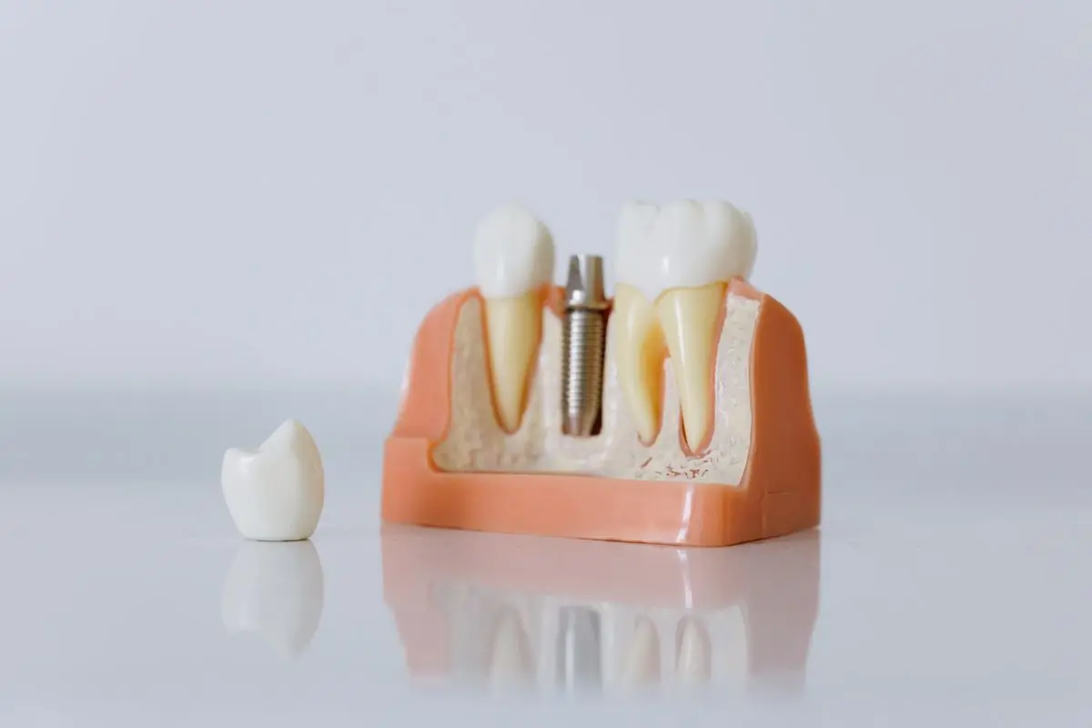 A model showing how an implant sits in the jaw